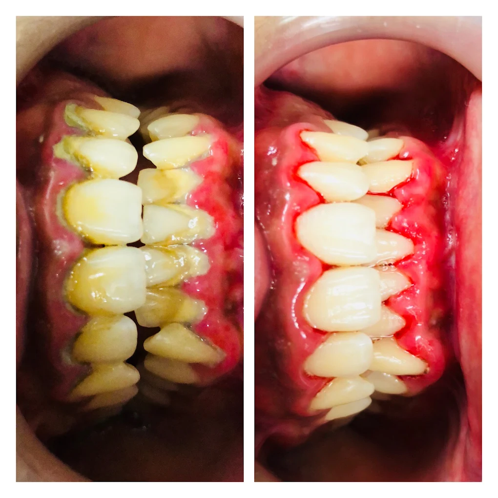Before and after comparison of stained teeth following a dental treatment