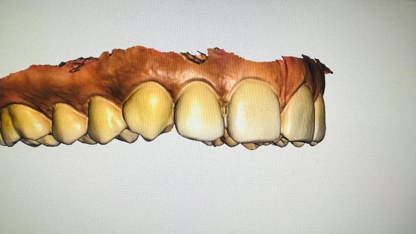 3D digital scan view of upper front teeth used in dental treatment planning