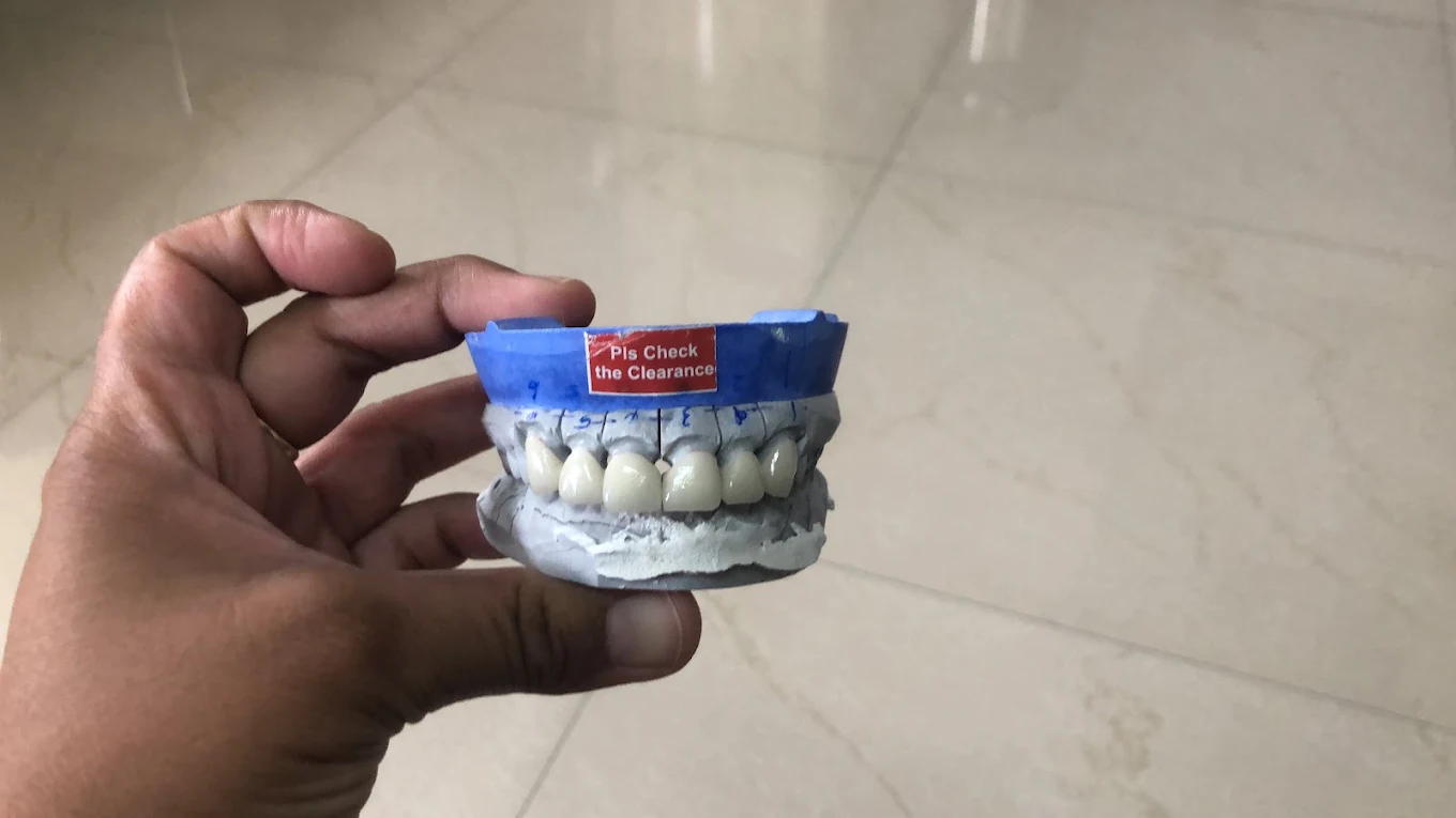 Dental study model of teeth held in a hand during a treatment discussion