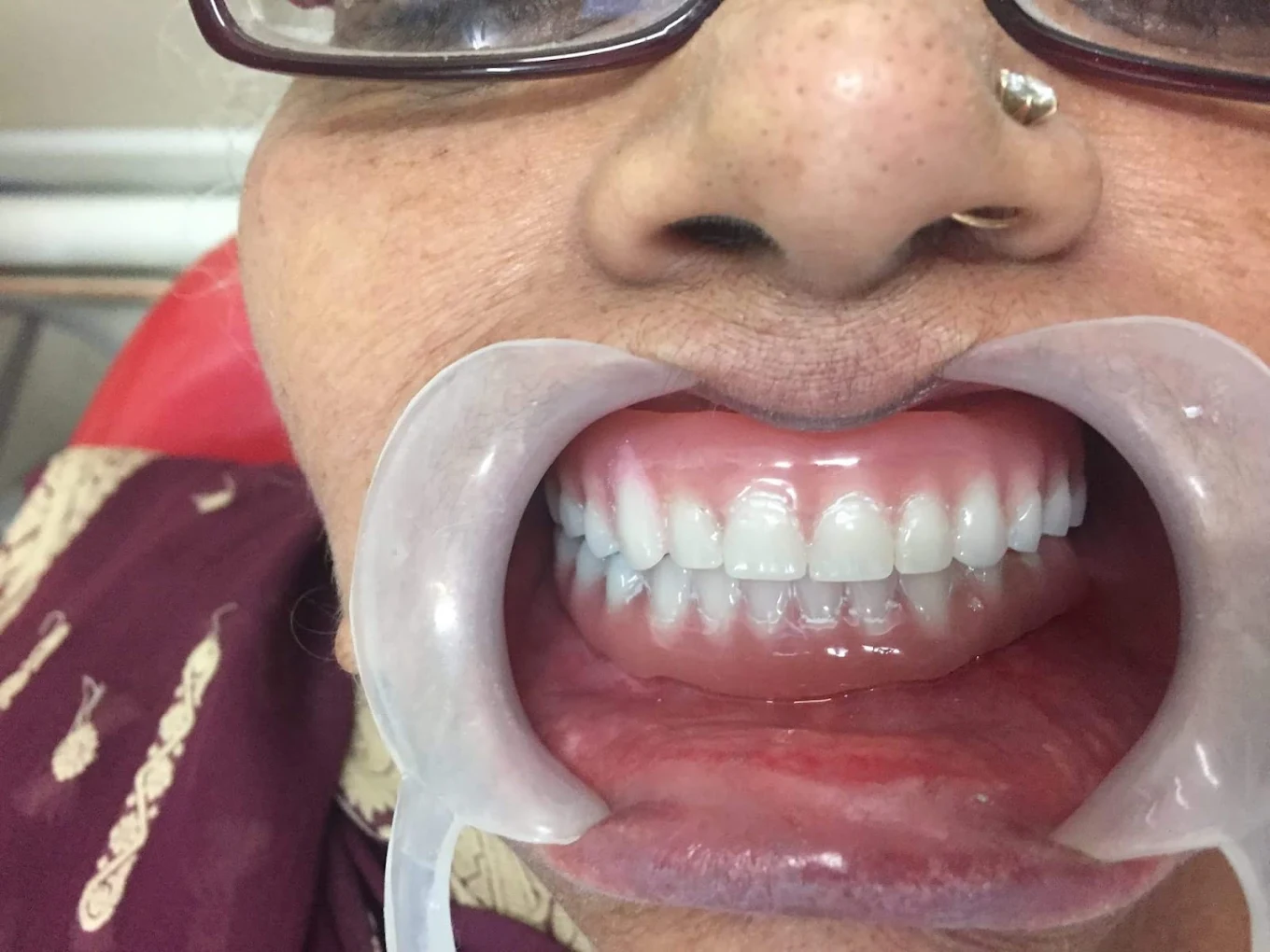Patient's smile photographed with a cheek retractor during a dental visit at Your Dentist, Malviya Nagar, Jaipur
