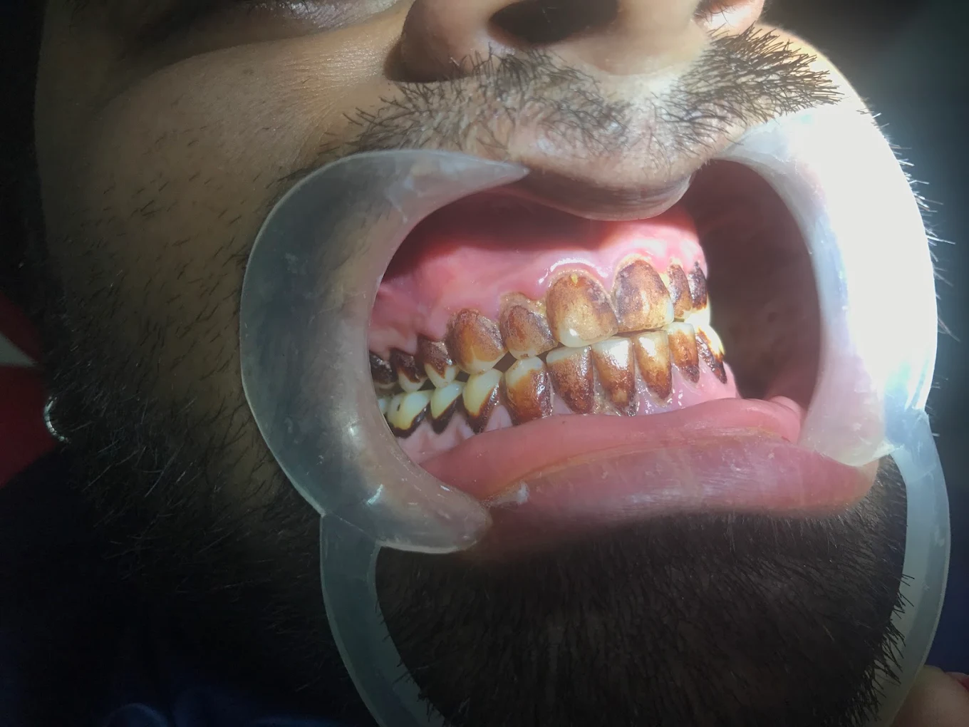 Metal braces on a patient's teeth, shown with a cheek retractor