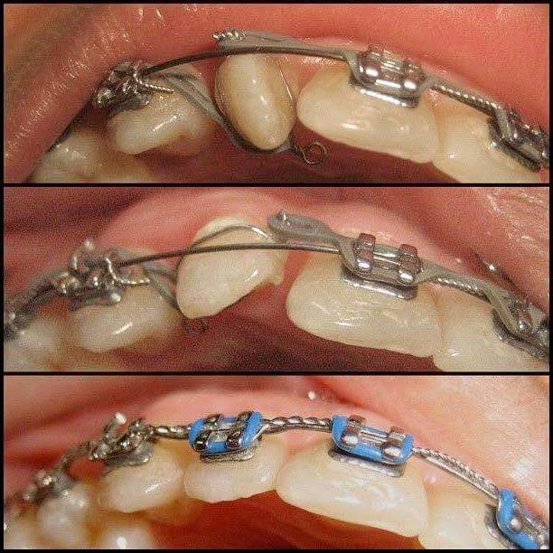 Close-up of orthodontic braces and wire on upper teeth during treatment