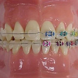 Close-up of braces with coloured elastic bands on upper and lower teeth