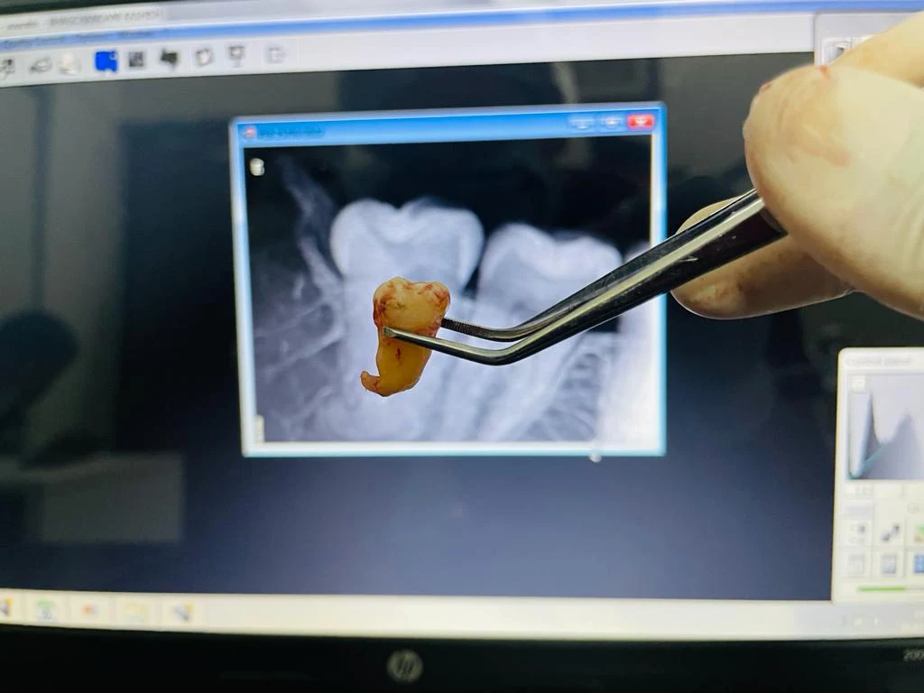 Dental examination for gum health at Your Dentist Jaipur