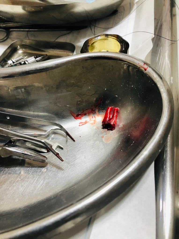 Dental instruments in a tray after a tooth extraction procedure