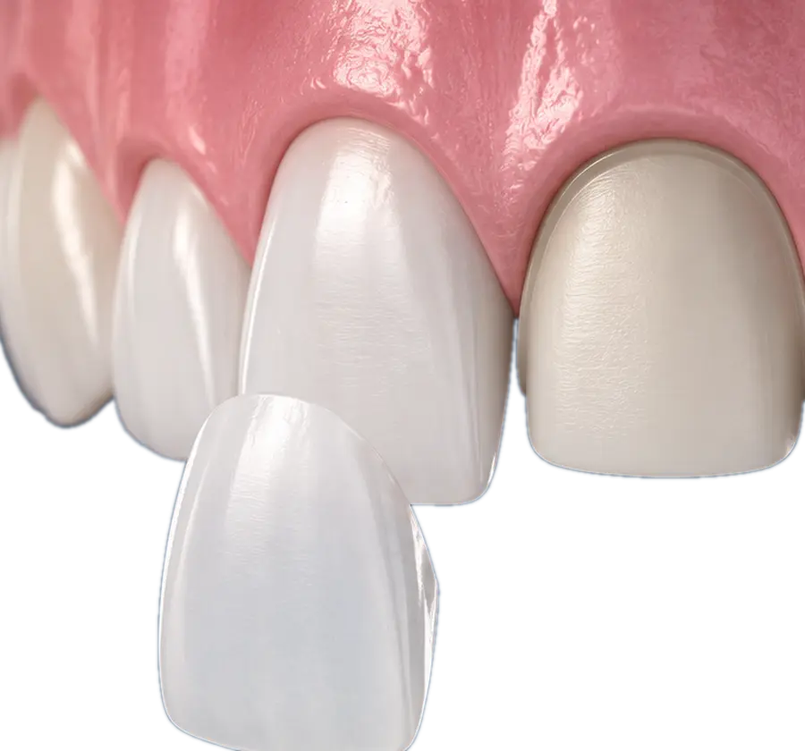 Custom Veneer – dental veneer smile makeover